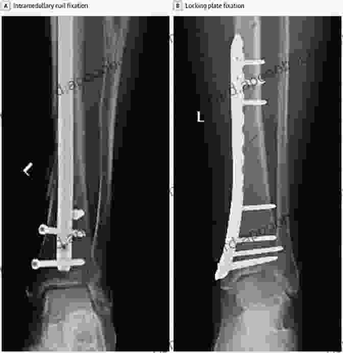 Intramedullary Nails For Bone Fixation And Stabilization Materials And Devices For Bone DisFree Downloads