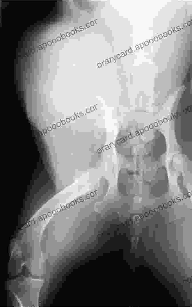 Pelvic Bone Tumor Surgery Of Pelvic Bone Tumors