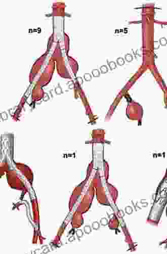 Surgery Of Vertebrobasilar Aneurysms: London Ontario Experience On 1767 Patients